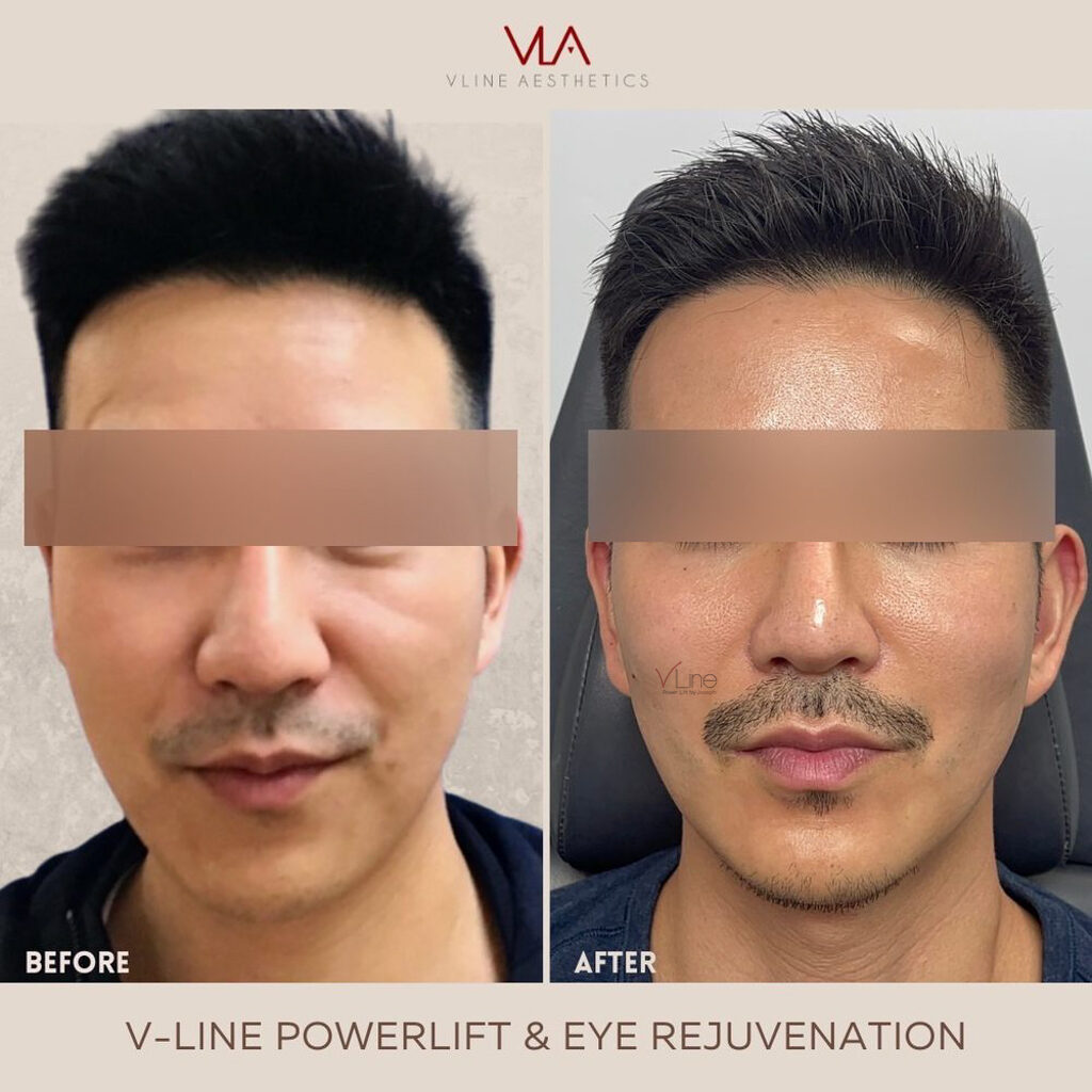 V Line Power Lift and Eye Rejuvenation-2