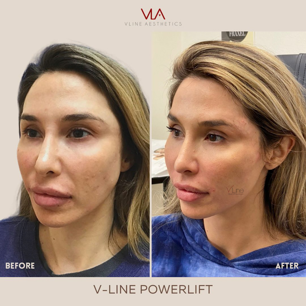 V Line Power Lift profile