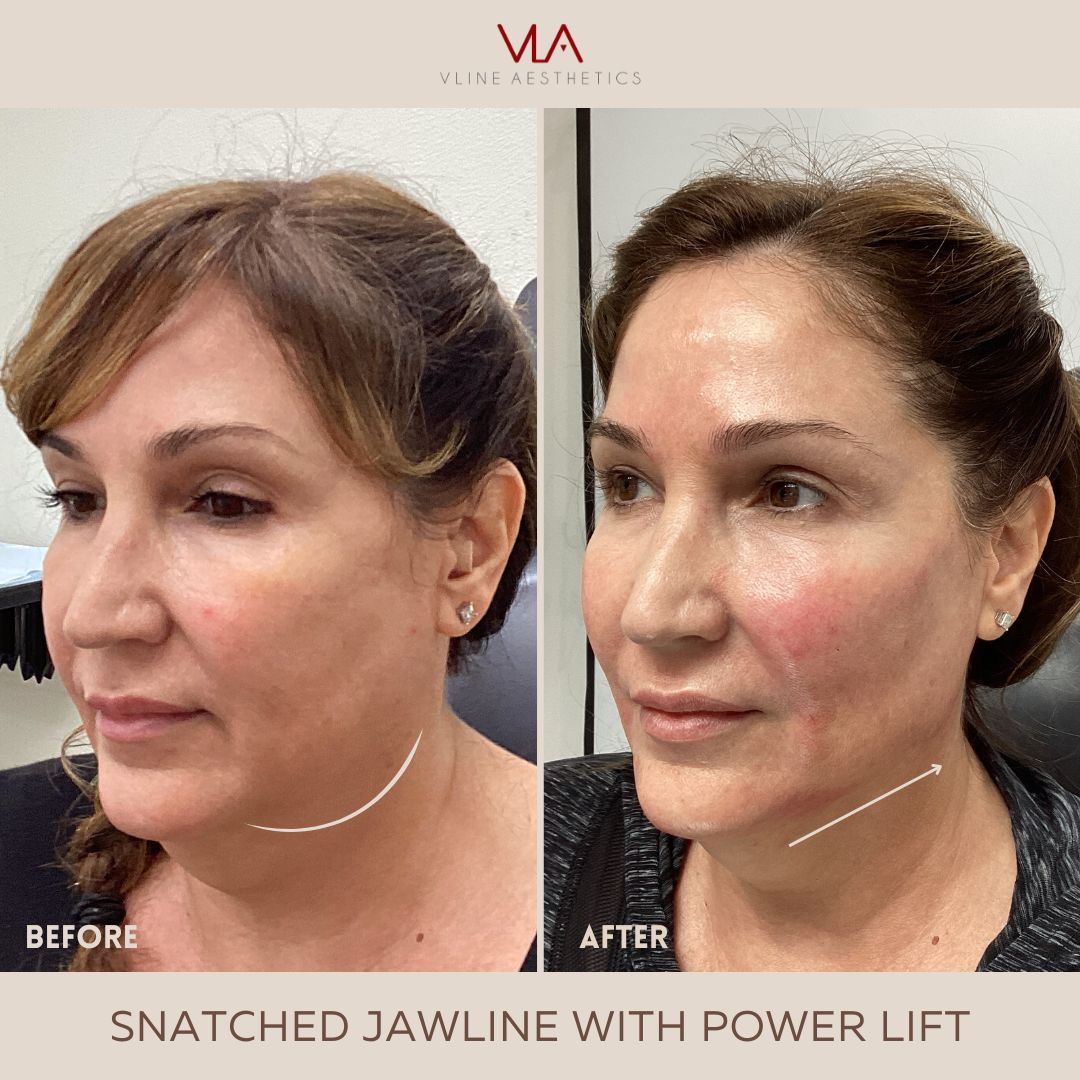V Lift and Jawline Contour Skin Perfect Brothers