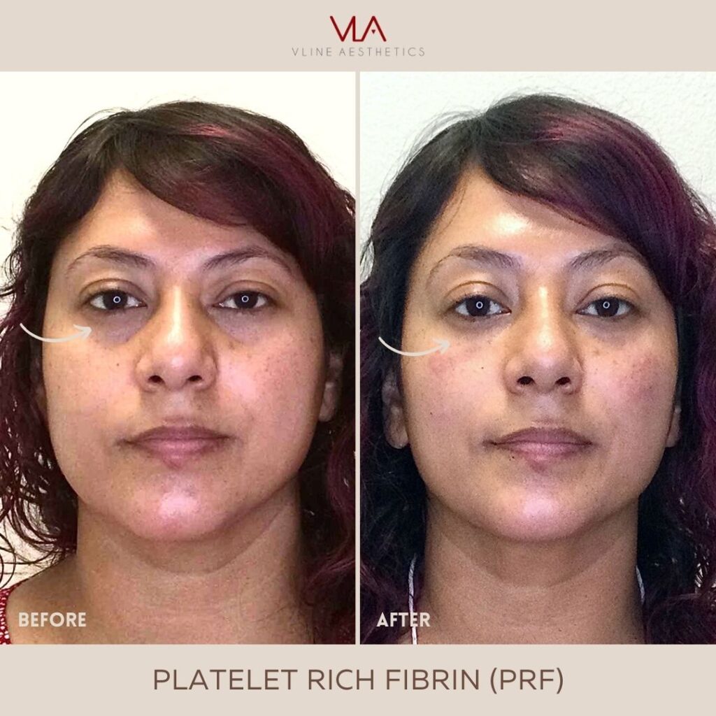 Eye-Rejuvenation-PLATELET-RICH-FIBRIN-Joseph-1
