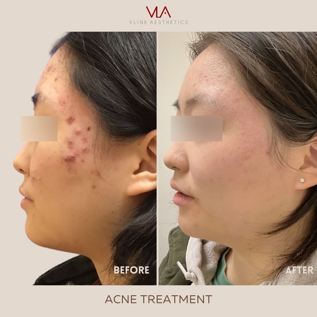 ACNE-SCARS