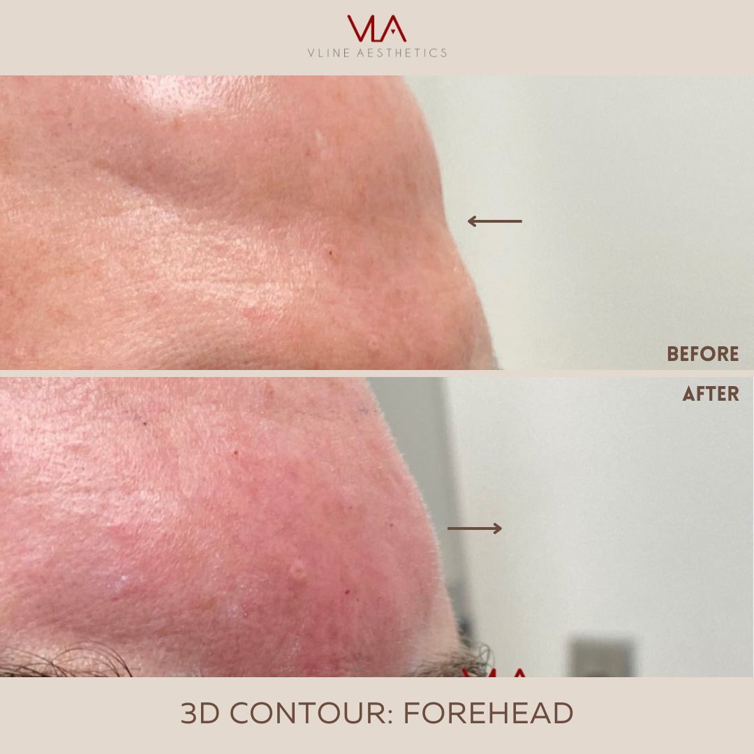 3D Contour Forehead