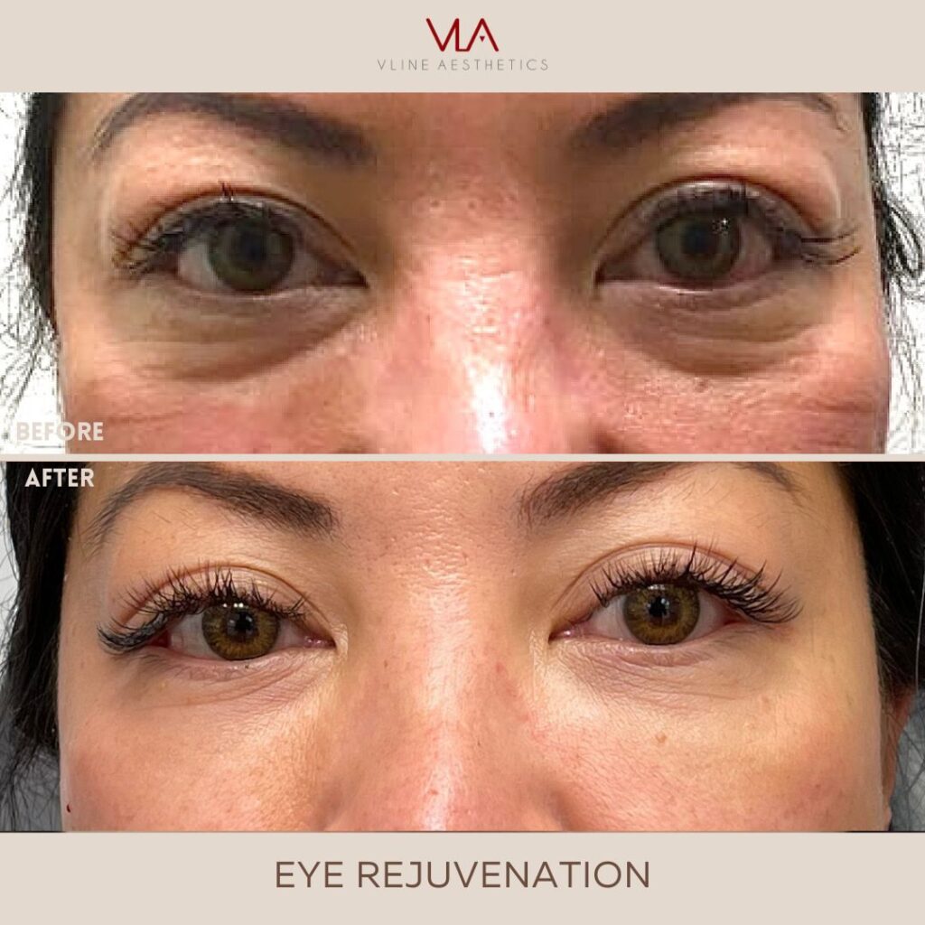 Eye Rejuvenation
