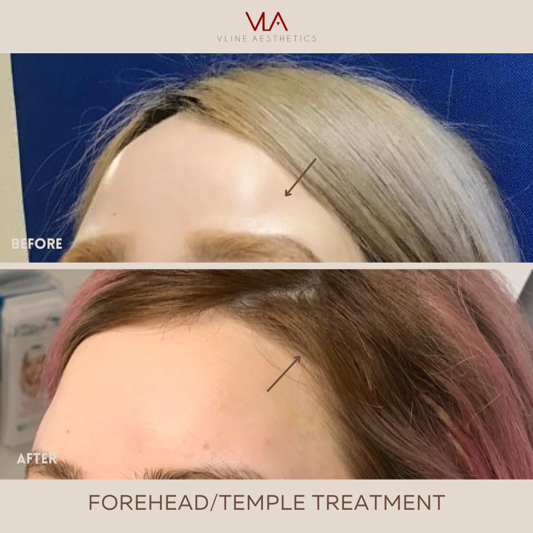 Forehead Temple Contour