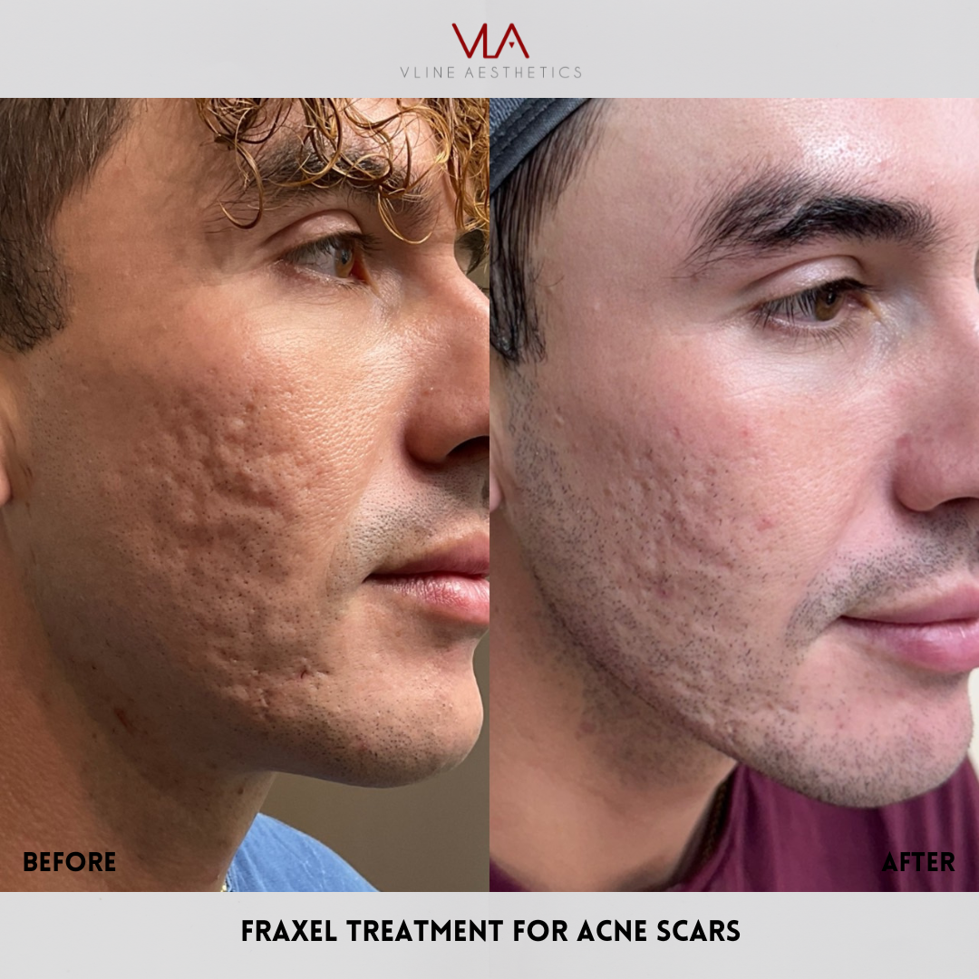 Acne Scar 2